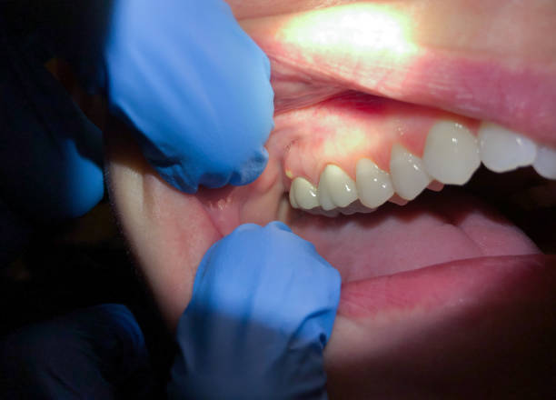 Best Emergency Denture Repair in Marion, IN