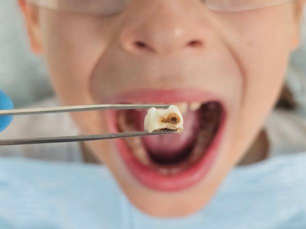 Best Emergency Root Canal Treatment in Marion, IN